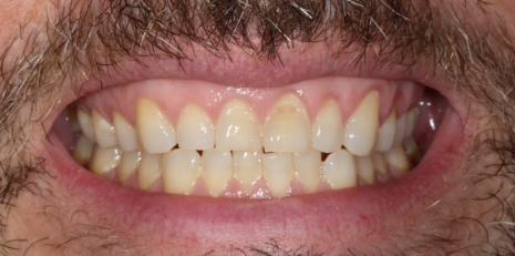 Close up of damaged smile before full mouth reconstruction